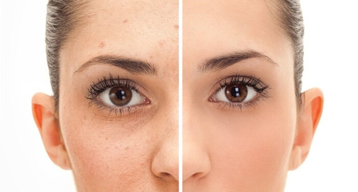 Fractional-CO2-Laser-Treatment-Risks-and-Complications-700x375