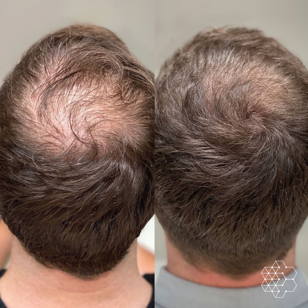 Hair-Restoration-photo-3-1