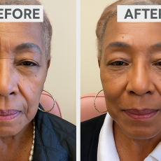 botox-before-after-1